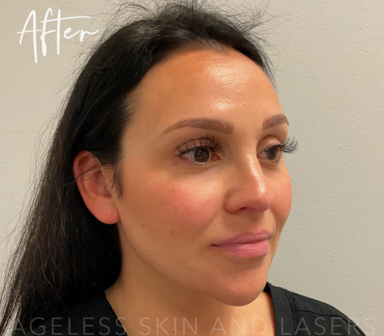 After Image: Full Facial Balancing with Dermal Filler - right-front-oblique