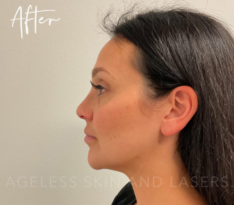 After Image: Full Facial Balancing with Dermal Filler - left-side