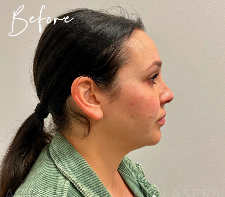 Before Image: Full Facial Balancing with Dermal Filler - right-side