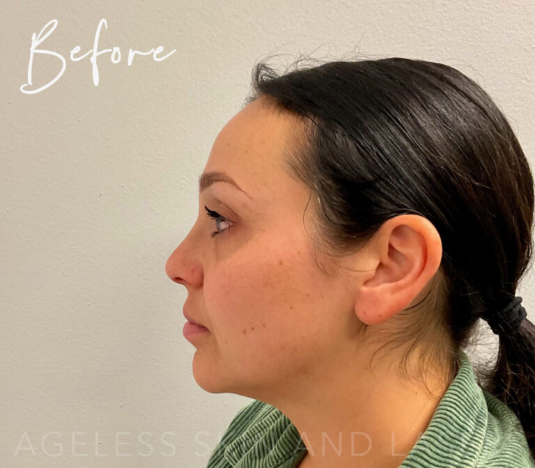 Before Image: Full Facial Balancing with Dermal Filler - left-side